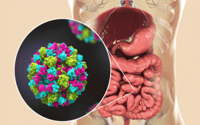 Viêm dạ dày ruột: Nguyên nhân và cách đối phó