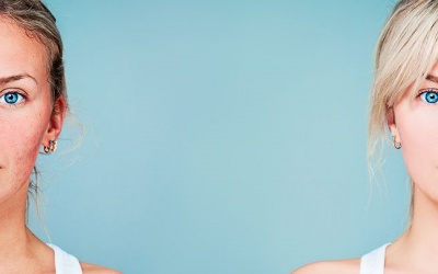 Làm sao để làm mờ sẹo do mụn trứng cá? 