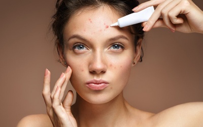 Mụn trứng cá ở người trưởng thành: Ăn uống thế nào để khắc phục?