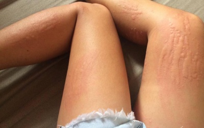 Cải thiện viêm da cơ địa dị ứng bằng cách nào?