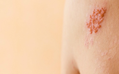 Nổi mụn nước nhỏ, đau rát bên sườn có phải giời leo?