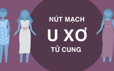 Nút mạch: Phương pháp điều trị u xơ tử cung không cần phẫu thuật