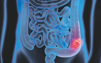 Ung thư đại tràng: Triệu chứng và nguyên nhân gây bệnh