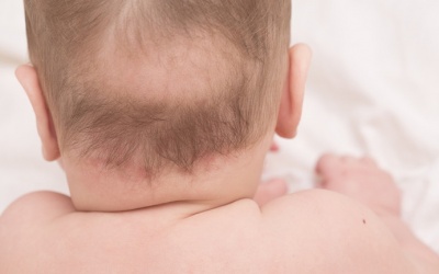 Trẻ em bị rụng tóc: Nguyên nhân và cách khắc phục