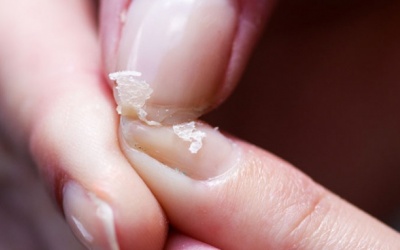 Móng tay bong tróc và dễ gãy có cần bổ sung chất gì không?