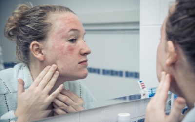 Làm sao để giảm vẩy nến trên khuôn mặt?