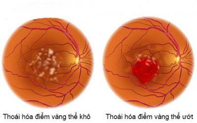 Laser có giúp giảm thoái hóa điểm vàng? 
