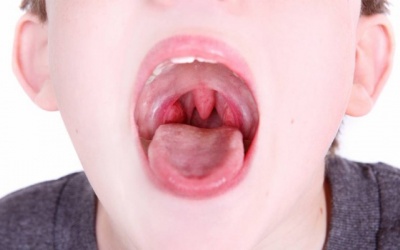 Video: Những điều bạn cần biết về viêm amidan