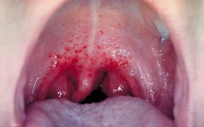 Những thông tin cần biết về viêm họng liên cầu khuẩn