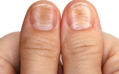 Đường vân trên móng tay của bạn cảnh báo điều gì?