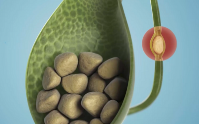 Sỏi túi mật có triệu chứng gì, điều trị thế nào?