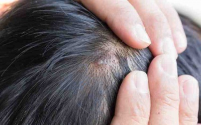 5 phương pháp giúp điều trị bệnh vẩy nến da đầu hiệu quả