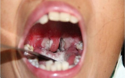 Bệnh bạch hầu là gì và nó nguy hiểm như thế nào?