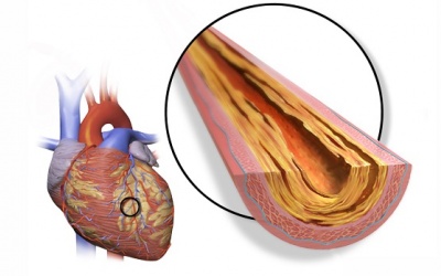 Thiếu máu cơ tim cục bộ nguy hiểm đến mức nào?