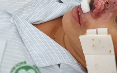 Hy hữu: Người phụ nữ bị 'ăn' cánh mũi do mắc bệnh truyền nhiễm