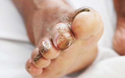 Lại có thêm bệnh nhân bị vi khuẩn 'ăn thịt người' xâm nhập