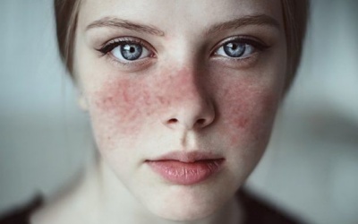 7 thông tin cần biết về bệnh lupus