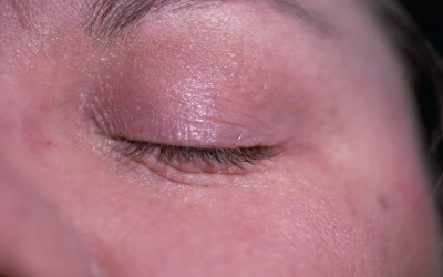 Chàm xung quanh mắt, đừng quên kem thảo dược Eczestop