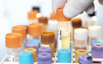 Xét nghiệm nước tiểu giúp phát hiện ung thư tuyến tụy từ giai đoạn sớm