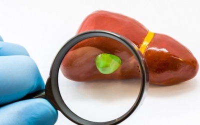 Bạn có nằm trong số những người có nguy cơ cao bị sỏi mật?