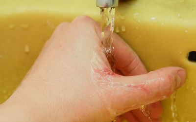 Dùng gel Subạc có làm dịu vết đốt của kiến ba khoang?