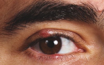 Video: Hướng dẫn cách trị lẹo mắt, lên chắp ở mắt tại nhà