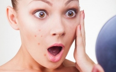 5 lời khuyên của bác sỹ da liễu khi điều trị mụn trứng cá