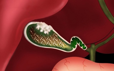 Đa polyp túi mật: Triệu chứng cảnh báo và cách điều trị hiệu quả