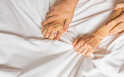 5 loại thực phẩm cần tránh khi mắc bệnh vẩy nến