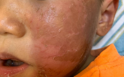 Đeo mặt nạ chơi Halloween, một em nhỏ bỏng rộp da mặt