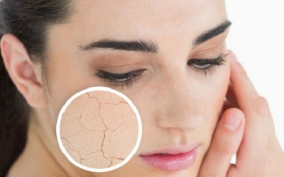 Ngăn ngừa khô da mùa Đông bằng các biện pháp tự nhiên