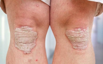 Video: Muốn giảm triệu chứng bệnh vẩy nến, hãy giảm cân