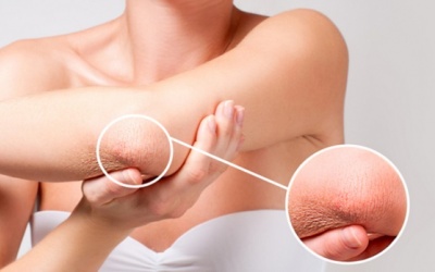 Một số biến chứng đái tháo đường trên da thường gặp nhất