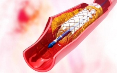 Stent là gì và khi nào người bệnh mạch vành phải đặt stent?