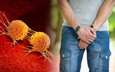 5 dấu hiệu cảnh báo ung thư tuyến tiền liệt không được bỏ qua