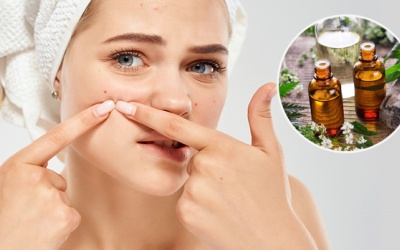 Dùng tinh dầu để trị mụn trứng cá cần lưu ý gì, cách dùng thế nào?