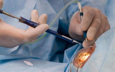 Chảy nước mắt, sưng mắt sau phẫu thuật thay thủy tinh thể do đâu? 