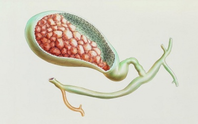 8 điều bạn có thể làm để phòng ngừa sỏi mật