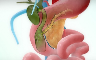 Nang ống mật chủ là gì, có triệu chứng gì cảnh báo?