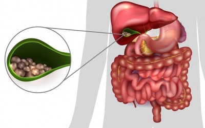 Sỏi mật không phải do ứ mật, không gây đau đớn có cần điều trị?