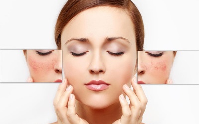 Bật mí 6 lời khuyên giúp chăm sóc da nhạy cảm tốt hơn