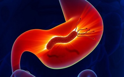 Khi nào vi khuẩn HP gây ra ung thư dạ dày?