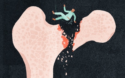 Bổ sung một mình vitamin D không thể giúp ngăn gãy xương