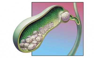 Chuyên gia chia sẻ về bệnh sỏi mật: Triệu chứng và cách điều trị