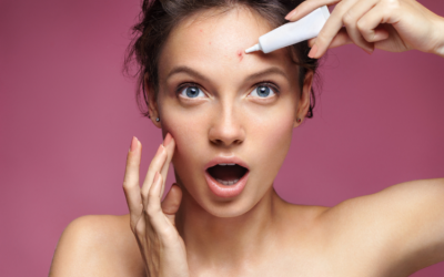 Làm sao để điều trị mụn trứng cá khi mang thai? 