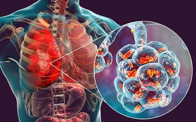 Nhận biết 8 triệu chứng điển hình của bệnh viêm phổi 