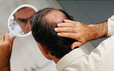 Tại sao đàn ông lại bị hói đầu?