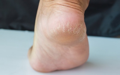 5 biện pháp tự nhiên trị nứt nẻ gót chân tại nhà