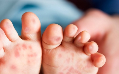 Có nên bôi gel Subạc vào mụn nước ở trẻ nhỏ?