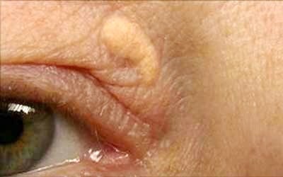 Có nên ngừa tích tụ u vàng cholesterol vùng mắt bằng TPCN?